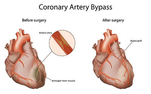 Coronary Artery Bypass Surgery