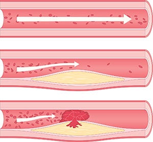 Atherosclerosis diagram